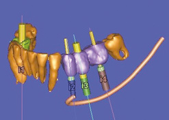 3d-implantat-planung